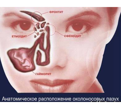 Спрей у разі гаймориту Вековий Схід