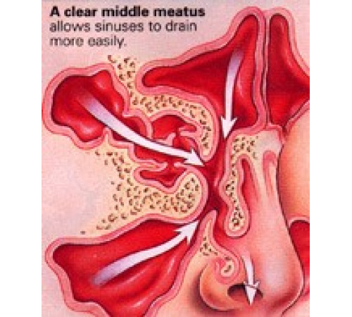 Спрей у разі гаймориту Вековий Схід