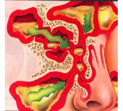 Спрей у разі гаймориту Вековий Схід