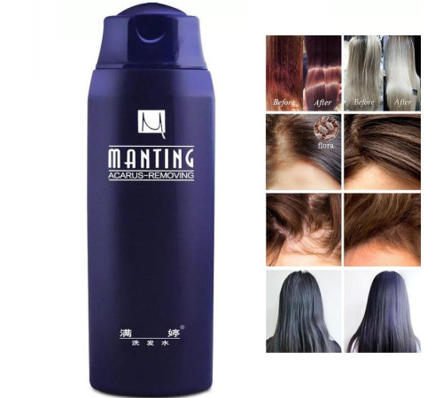 Шампунь Мантинг під час демодекозу голови та псоріазу