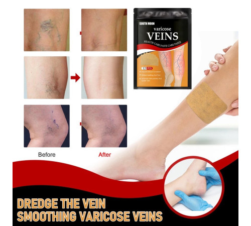 Пластир проти варикозного розширення вен із турмаліном, полегшення болю в ногах, набряк, пластир із дощовим червом