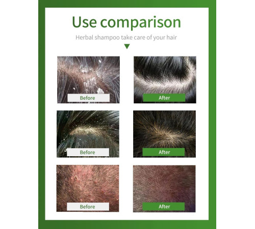 Шампунь від демодекозу, псоріазу, лупи та себореї Zudaifu