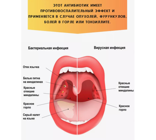 Протизапальні таблетки Pudilan Xiaoyan Pian  у разі фурункульозу, фарингіту, тонзиліту, ангіні, ГРВ Грип