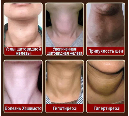 Крем-гель у разі проблем щитоподібної залози та усунути запалення в місцях вузлів щитоподібної залози 50 грамів